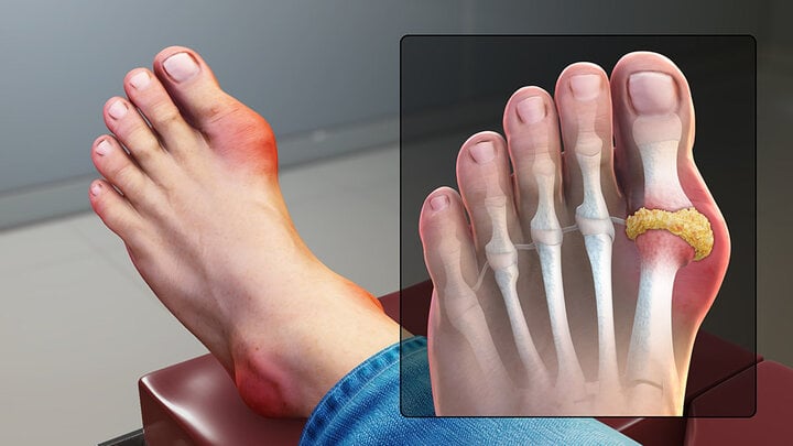 Bệnh gout có xu hướng trẻ hóa. (Ảnh minh họa: Sở Y tế TP.HCM)