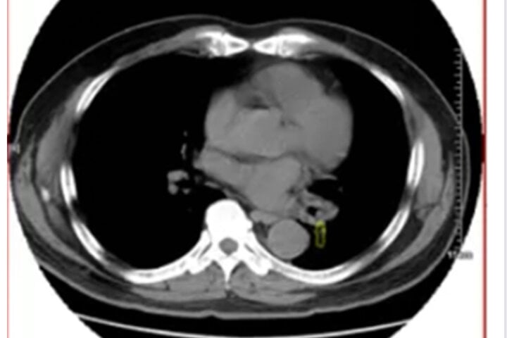 Ảnh chụp phổi của ông Long. (Ảnh: Sohu)