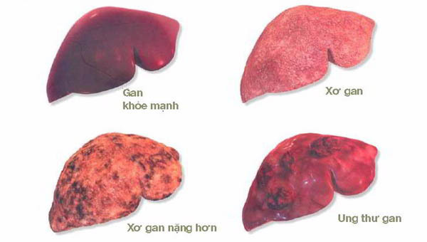 Ung thư gan giai đoạn đầu là sự xuất hiện khối u ở gan, các tế bào ung thư chưa xâm lấn hạch bạch huyết và di căn cơ quan xa.