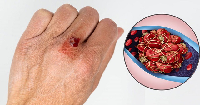 Bất ngờ 6 thực phẩm rẻ tiền làm tan cục máu đông, người Việt nên ăn để phòng đột quỵ- Ảnh 2. Bất ngờ 6 thực phẩm rẻ tiền làm tan cục máu đông, người Việt nên ăn để phòng đột quỵ- Ảnh 2.