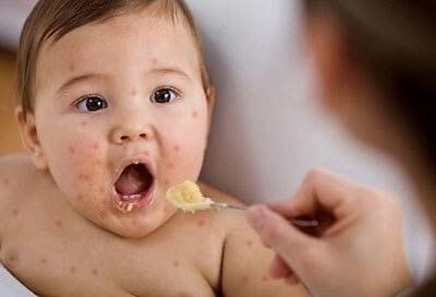 Những triệu chứng của bệnh tay chân miệng ở trẻ - Ảnh 2. Những triệu chứng của bệnh tay chân miệng ở trẻ - Ảnh 2.