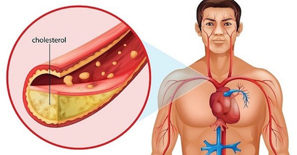 6 loại dầu ăn tốt cho người bị cholesterol cao- Ảnh 1.