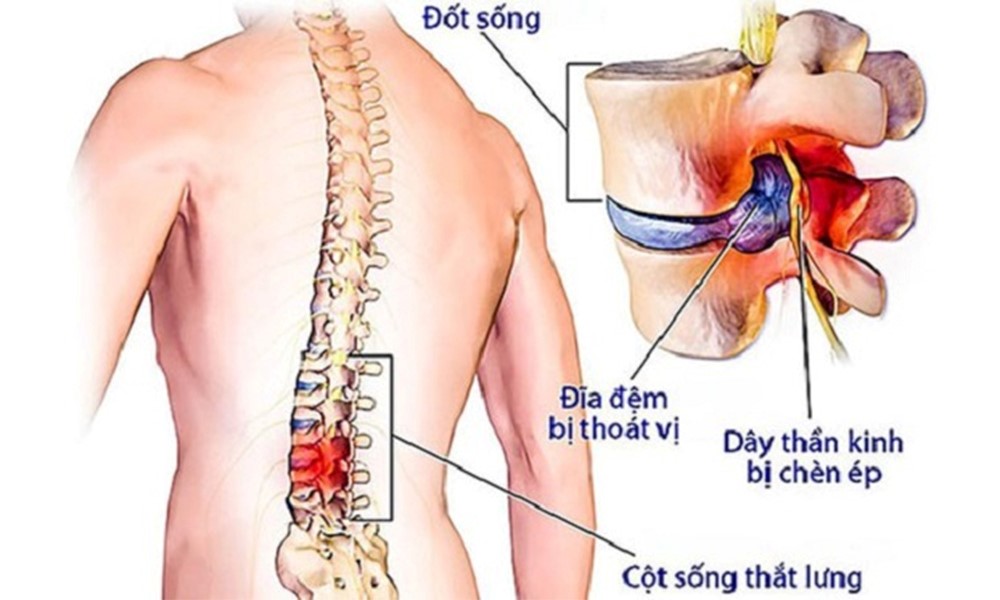 5 lý do gây thoát vị đĩa đệm ai cũng nên biết- Ảnh 2.