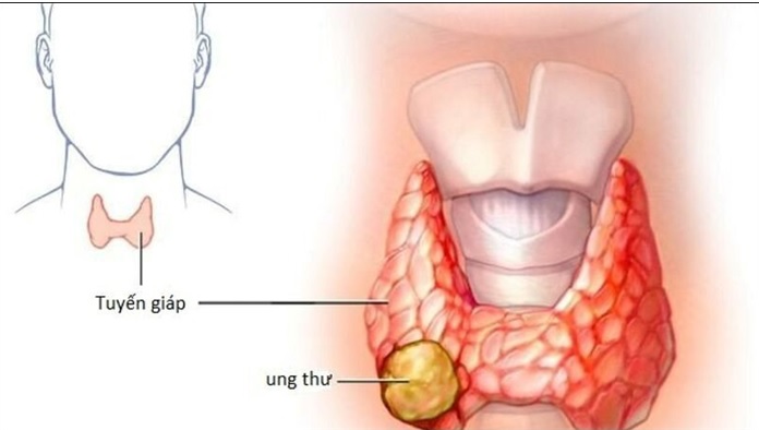 Các dấu hiệu điển hình của ung thư tuyến giáp ai cũng cần biết- Ảnh 1.