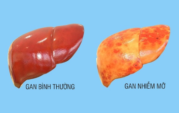 6 biến chứng đáng sợ của bệnh gan nhiễm mỡ, người mắc bệnh cần biết điều này để phòng biến chứng - Ảnh 2.