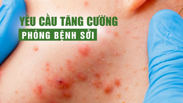 10 thông điệp về bệnh sởi nhất định không được bỏ qua! - Ảnh 2.