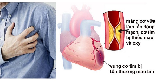Bệnh mạch vành gây biến chứng nguy hiểm- Ảnh 1. Bệnh mạch vành gây biến chứng nguy hiểm- Ảnh 1.