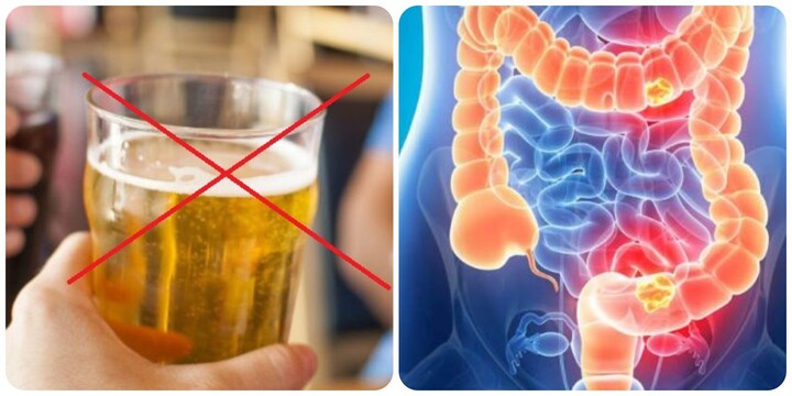 Bỏ rượu bia, thuốc lá là cách phòng ngừa ung thư đại trực tràng hiệu quả nhất