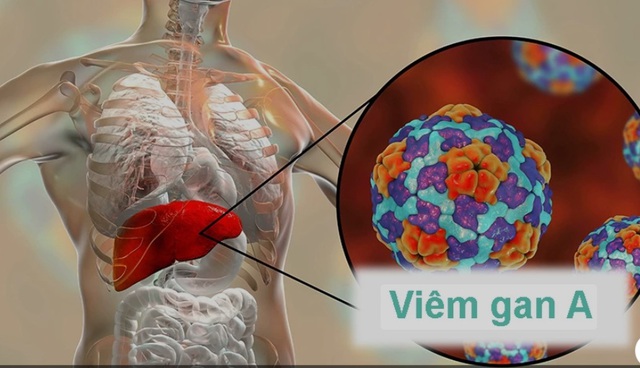 Lưu ý 6 nhóm thực phẩm gây hại gan, không nên ăn để phòng bệnh viêm gan A - Ảnh 2.