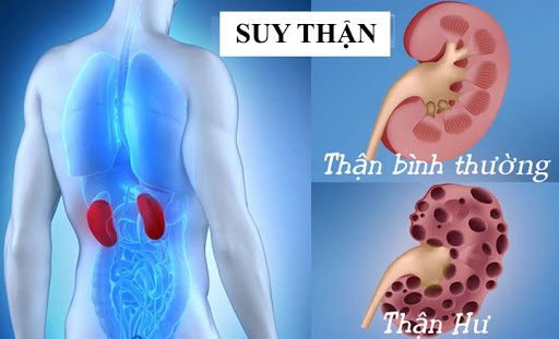 7 việc nên làm để phòng nguy cơ suy thận - Ảnh 3.