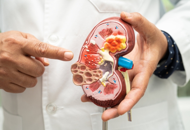 Bất ngờ 4 loại rau củ mùa hè người bệnh suy thận không nên ăn thường xuyên- Ảnh 2.