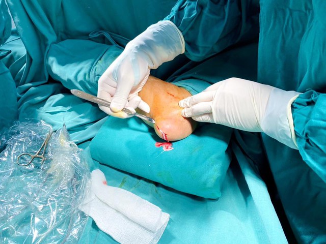 Cảnh giác với biến chứng nguy hiểm của bệnh gout- Ảnh 2.