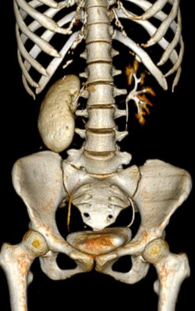 Cô gái 18 tuổi có thận 'hóa đá' và những sai lầm tàn phá thận một cách nhanh chóng của nhiều người - Ảnh 1.
