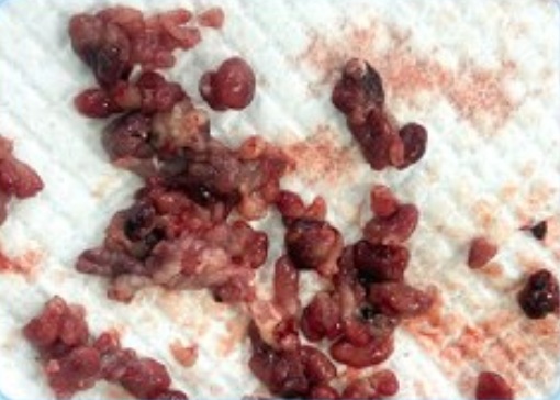 Phát hiện hàng trăm polyp bám chi chít trong ruột nam sinh 17 tuổi từ dấu hiệu nhiều người Việt bỏ qua  - Ảnh 3.