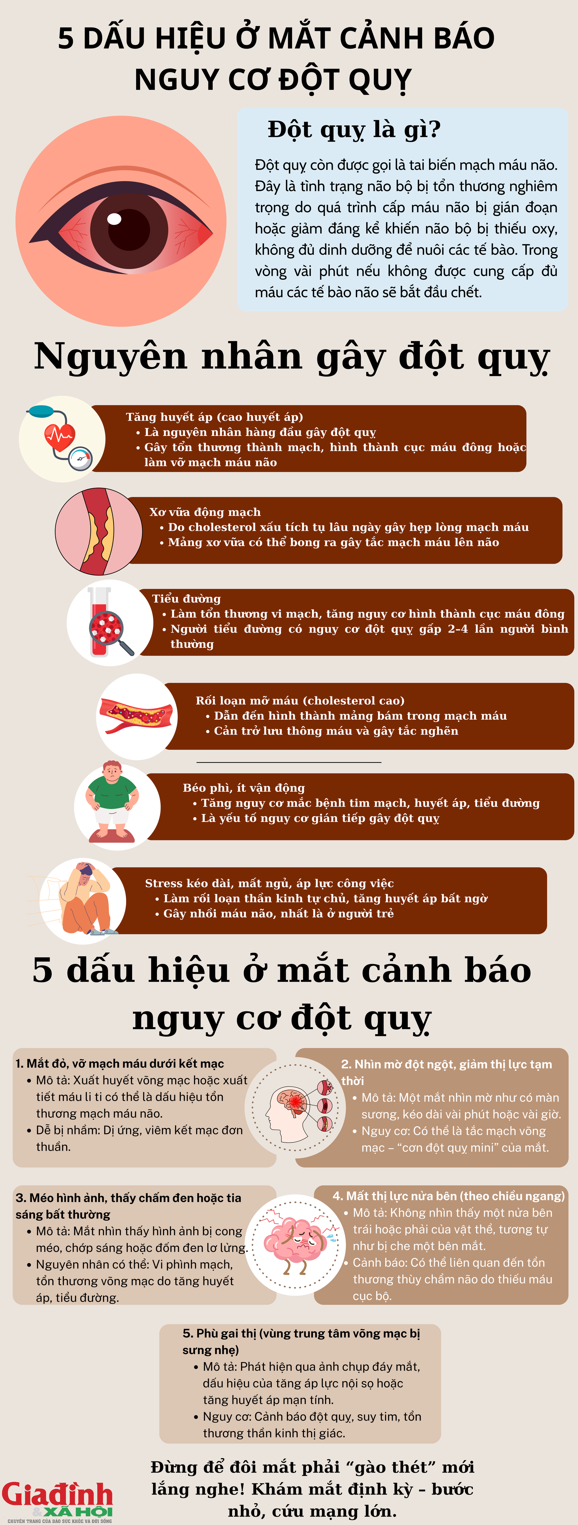 5 dấu hiệu ở mắt cảnh báo nguy cơ đột quỵ mà nhiều người vẫn chưa biết- Ảnh 1. 5 dấu hiệu ở mắt cảnh báo nguy cơ đột quỵ mà nhiều người vẫn chưa biết- Ảnh 1.