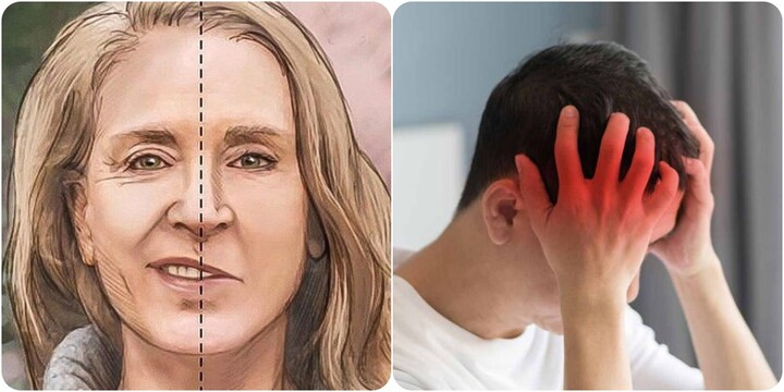 Nhận biết sớm các dấu hiệu đột quỵ có thể giảm thiểu các di chứng nguy hiểm