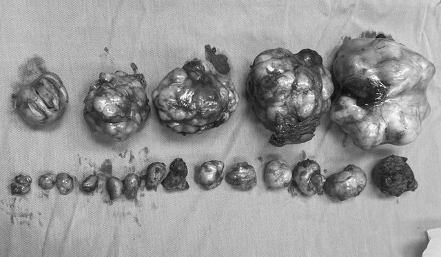 Bác sĩ ngỡ ngàng bóc tách 19 u xơ trong tử cung người bệnh: Nhập viện từ dấu hiệu nhiều chị em Việt bỏ qua - Ảnh 2.