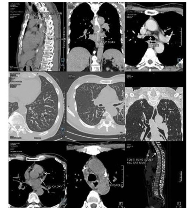 Người bệnh ung thư thực quản chia sẻ quyết định trị bệnh vì... chi phí rẻ hơn 10 lần- Ảnh 2.