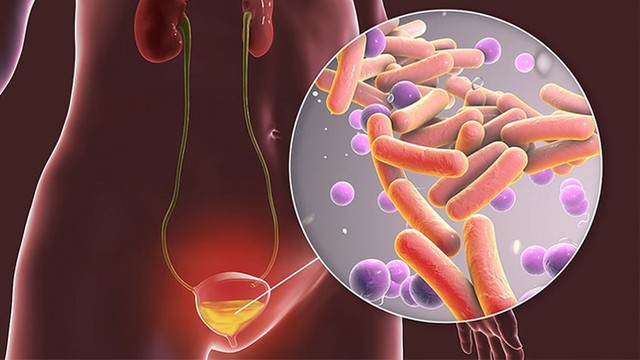 Người đàn ông 34 tuổi ở Thanh Hóa bị viêm bàng quang kéo dài, bác sĩ chỉ rõ biến chứng đáng sợ, cần cảnh giác - Ảnh 3.
