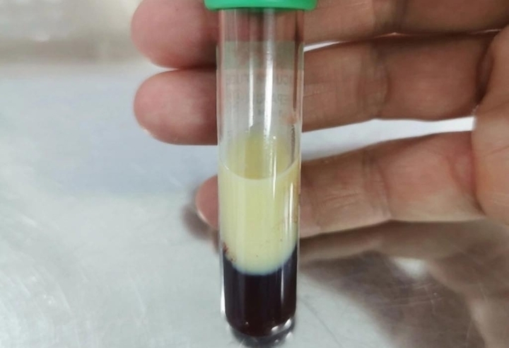 Mẫu máu của bệnh nhân tăng triglyceride. (Ảnh minh hoạ: BSCC)