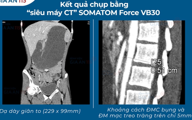 Ăn đủ mà vẫn đói: Nam thanh niên 27 tuổi đi khám phát hiện hội chứng hiếm gặp - Ảnh 2.