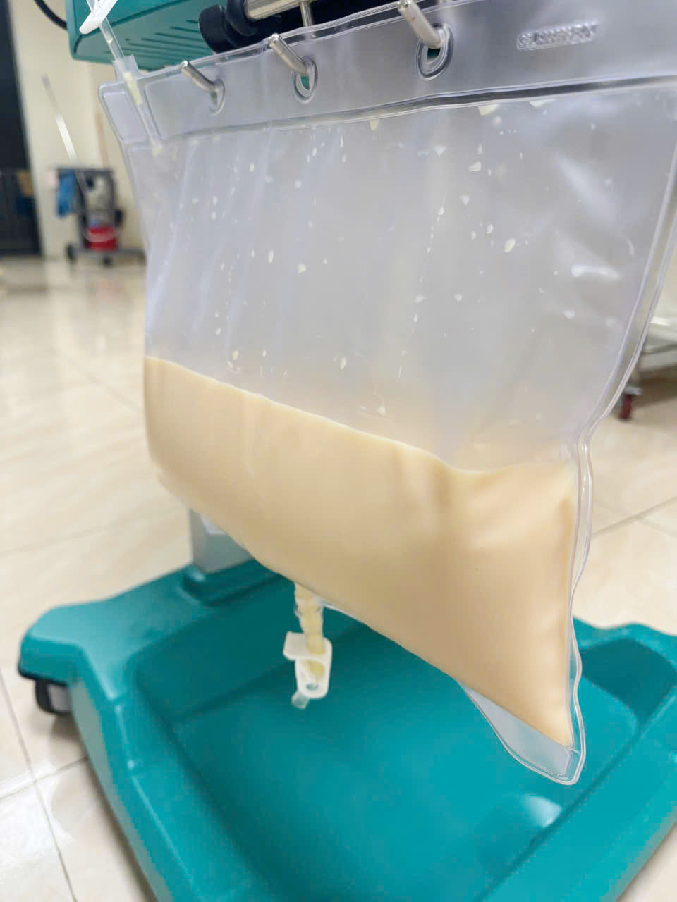 Bất ngờ chế độ ăn của người đàn ông có huyết tương trắng như sữa, triglycerid cao gấp 80 lần do... viêm tụy cấp - Ảnh 2.