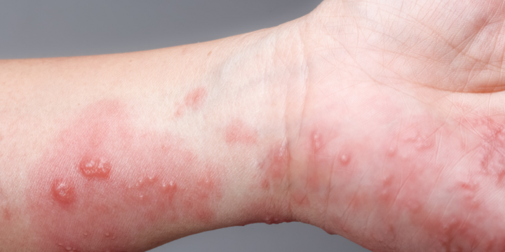 Có rất nhiều nguyên nhân dẫn đến kiến ba khoang cắn.