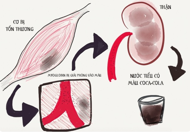 Thanh niên 23 tuổi tập gym, pickleball để ép cân, đi khám phát hiện tiêu vân cơ cấp - Ảnh 2.