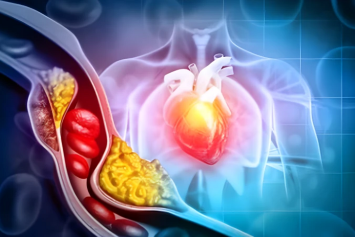 LDL nếu quá cao sẽ ảnh hưởng đến sức khỏe tim mạch.