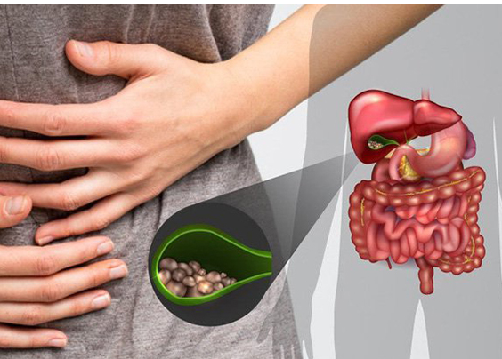 Đi khám vì đau bụng, bác sĩ lấy ra 30 viên sỏi mật trong người bệnh nhân 31 tuổi  - Ảnh 2.