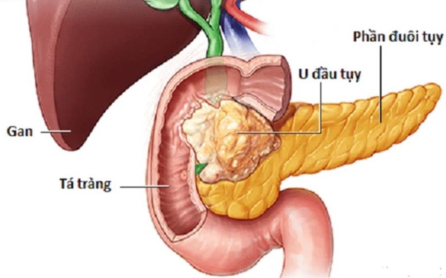 Mệt mỏi, sụt cân, người phụ nữ 65 tuổi đi khám phát hiện nổi u khắp người do mắc đa u nội tiết - Ảnh 2.