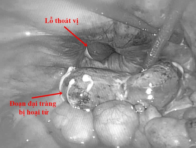 Người đàn ông suýt chết vì thoát vị bẹn, thừa nhận một sai lầm nhiều người Việt mắc phải - Ảnh 2. Người đàn ông suýt chết vì thoát vị bẹn, thừa nhận một sai lầm nhiều người Việt mắc phải - Ảnh 2.