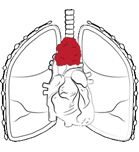 U trung thất và những lựa chọn phẫu thuật - Ảnh 1.