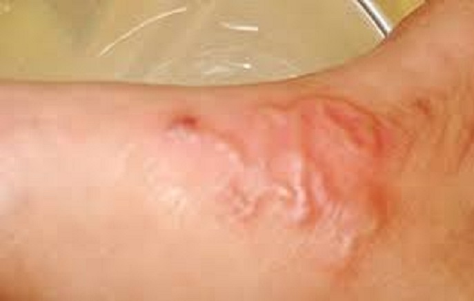 Nhiều trường hợp ở Khánh Hòa bị sán chó, người dân chủ động phòng bệnh- Ảnh 2.