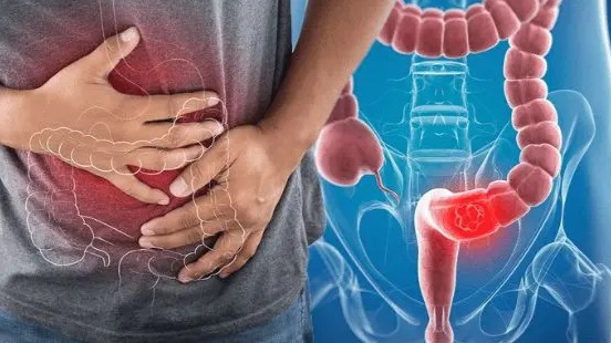 4 thói quen tăng nguy cơ ung thư đại trực tràng, người Việt nhất định phải tránh - Ảnh 6. 4 thói quen tăng nguy cơ ung thư đại trực tràng, người Việt nhất định phải tránh - Ảnh 6.