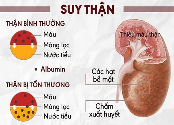 Cô gái 20 tuổi suy thận giai đoạn cuối, phải lọc máu, thừa nhận 1 sai lầm nhiều người Việt mắc phải - Ảnh 2.