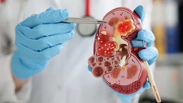 8 dấu hiệu bệnh suy thận, người Việt cần biết để phòng bệnh từ sớm - Ảnh 2. 8 dấu hiệu bệnh suy thận, người Việt cần biết để phòng bệnh từ sớm - Ảnh 2.