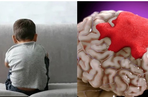 Bé trai 10 tuổi đột quỵ sau khi chơi cầu lông, bác sĩ cảnh báo dấu hiệu dễ bị bỏ qua ở trẻ - Ảnh 2. Bé trai 10 tuổi đột quỵ sau khi chơi cầu lông, bác sĩ cảnh báo dấu hiệu dễ bị bỏ qua ở trẻ - Ảnh 2.