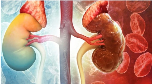 Cô gái 28 tuổi đối diện nguy cơ suy thận sai lầm trong lúc giảm cân nhiều người Việt mắc phải - Ảnh 2.