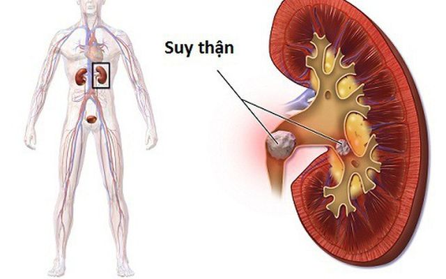 5 nhóm người có nguy cơ suy thận cao, người Việt cần biết để phòng tránh - Ảnh 2.