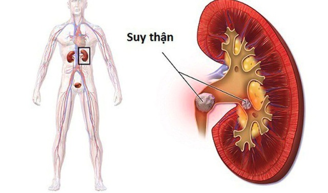 Bất ngờ phát hiện suy thận giai đoạn nặng từ dấu hiệu nhiều người Việt mắc phải nhưng dễ bỏ qua - Ảnh 2.