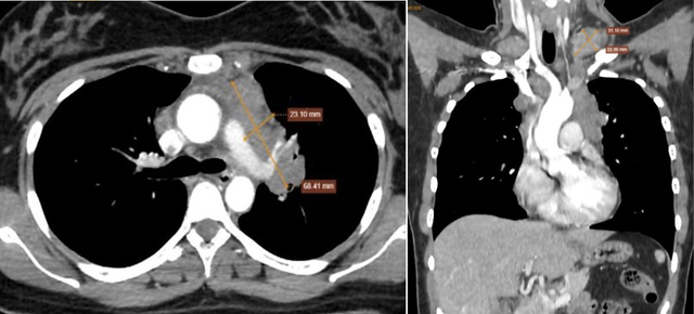 Cô gái 25 tuổi phát hiện mắc ung thư hạch từ dấu hiệu tưởng vô hại, nhiều người Việt bỏ qua - Ảnh 2. Cô gái 25 tuổi phát hiện mắc ung thư hạch từ dấu hiệu tưởng vô hại, nhiều người Việt bỏ qua - Ảnh 2.