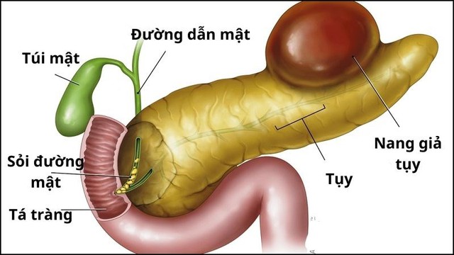 Người đàn ông 44 tuổi phát hiện viêm tụy cấp từ dấu hiệu nhiều người Việt mắc phải - Ảnh 2.