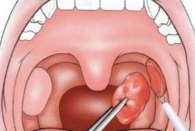 Người đàn ông 55 tuổi phát hiện ung thư amidan hiếm gặp từ dấu hiệu nhiều người Việt bỏ qua - Ảnh 2.