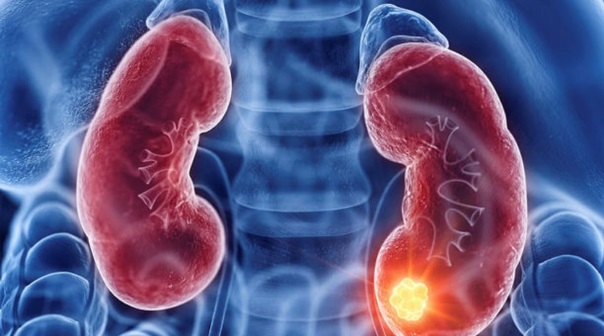 Người phụ nữ 67 tuổi bất ngờ phát hiện ung thư thận giai đoạn sớm từ 1 việc nhiều người Việt bỏ qua - Ảnh 2.