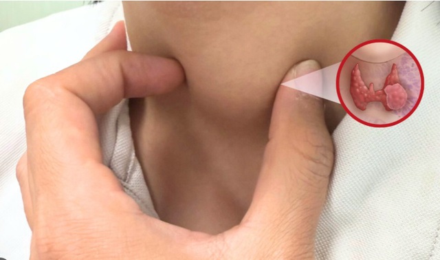 Người phụ nữ phát hiện ung thư tuyến giáp từ dấu hiệu nhiều người Việt bỏ qua - Ảnh 3.