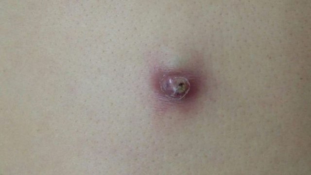 U bã đậu 10 năm bất ngờ hóa ung thư ở người đàn ông 40 tuổi, dấu hiệu cảnh báo nhiều người bỏ qua - Ảnh 2. U bã đậu 10 năm bất ngờ hóa ung thư ở người đàn ông 40 tuổi, dấu hiệu cảnh báo nhiều người bỏ qua - Ảnh 2.