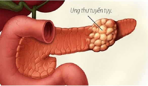Người đàn ông 30 tuổi bất ngờ phát hiện ung thư tụy từ dấu hiệu nhiều người Việt mắc phải - Ảnh 2.