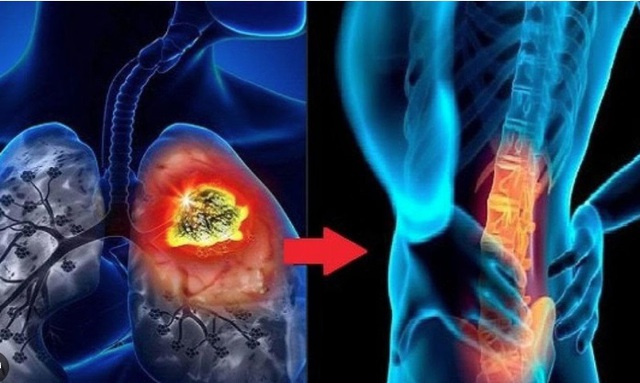 Người đàn ông 60 tuổi phát hiện ung thư phổi giai đoạn 4 di căn não từ dấu hiệu nhiều người Việt mắc phải - Ảnh 2.