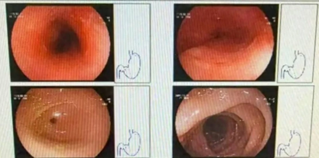 Loét thực quản vì thói quen ăn lẩu nóng: Cảnh báo sức khỏe 2026 - Ảnh 1. Loét thực quản vì thói quen ăn lẩu nóng: Cảnh báo sức khỏe 2026 - Ảnh 1.